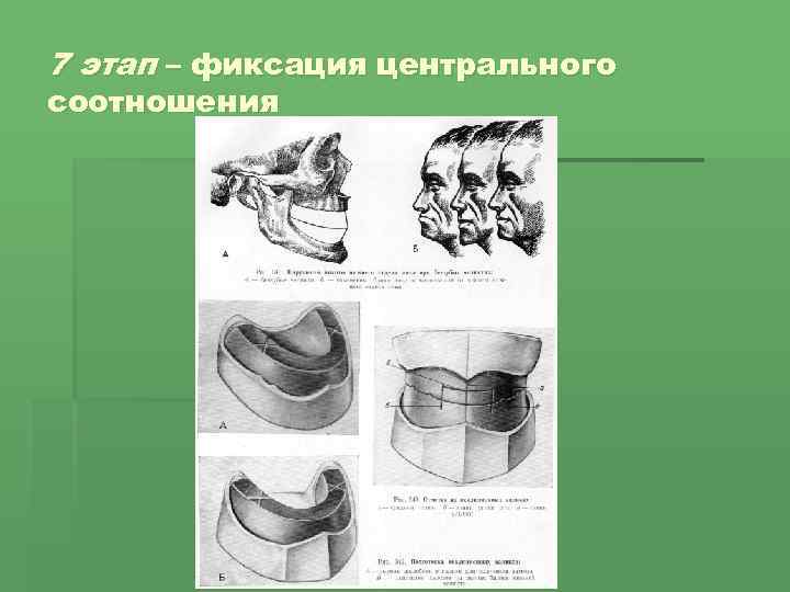 7 этап – фиксация центрального соотношения 