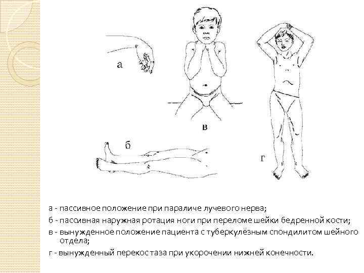 а - пассивное положение при параличе лучевого нерва; б - пассивная наружная ротация ноги