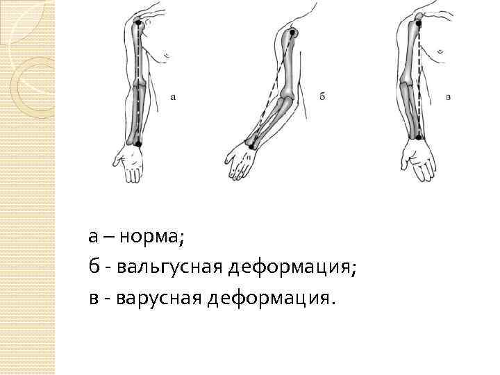 а – норма; б - вальгусная деформация; в - варусная деформация. 