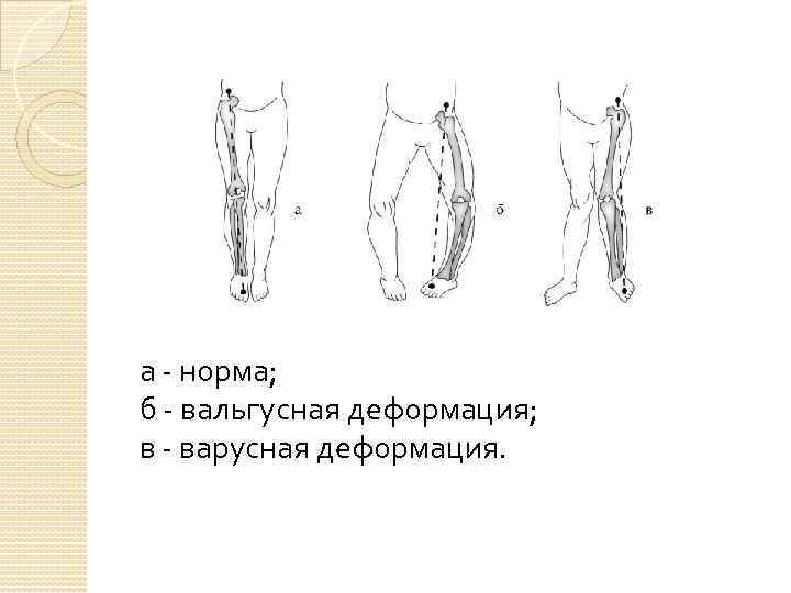 а - норма; б - вальгусная деформация; в - варусная деформация. 