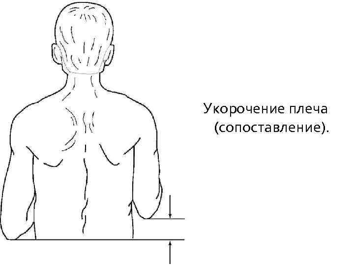 Укорочение плеча (сопоставление). 
