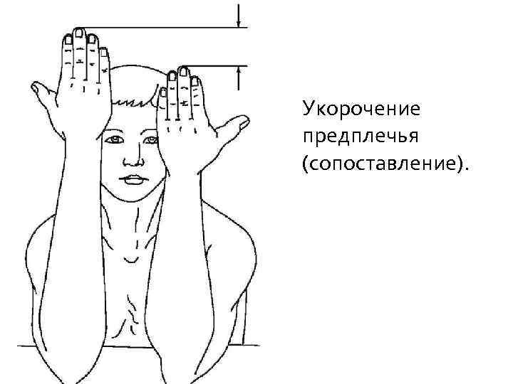 Укорочение предплечья (сопоставление). 