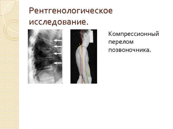 Рентгенологическое исследование. Компрессионный перелом позвоночника. 