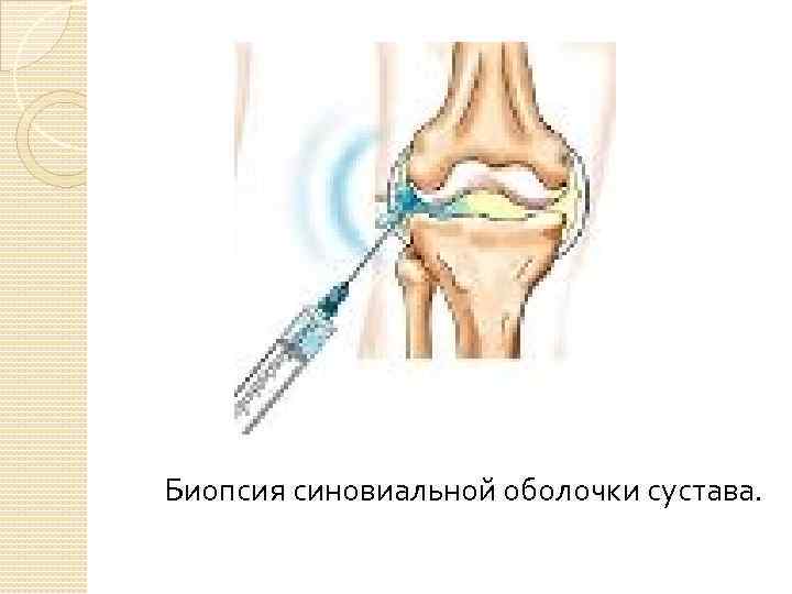 Биопсия синовиальной оболочки сустава. 