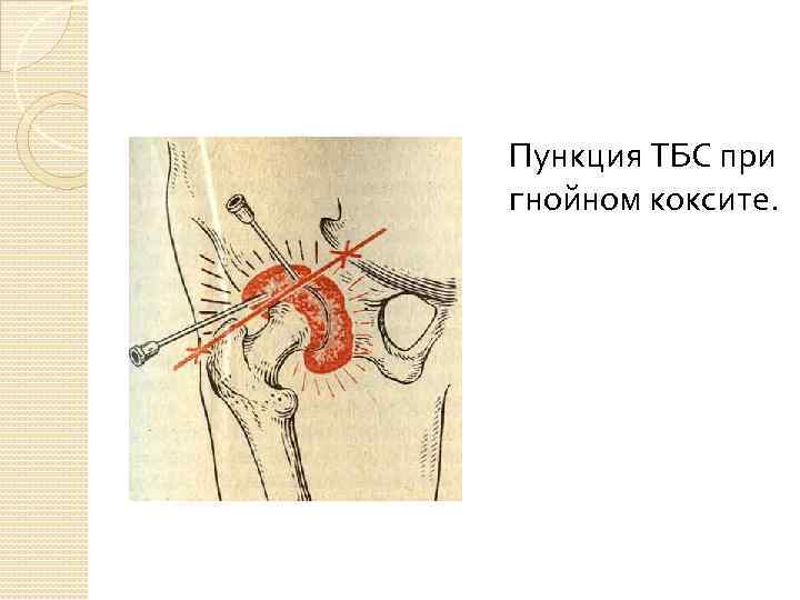 Пункция ТБС при гнойном коксите. 