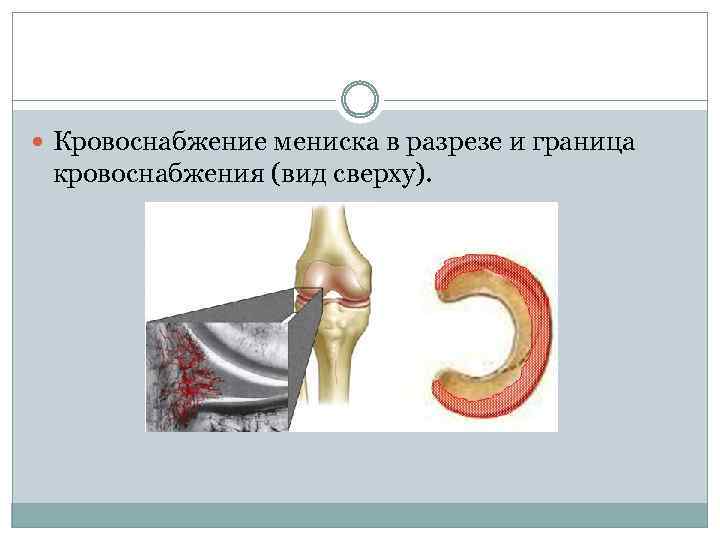  Кровоснабжение мениска в разрезе и граница кровоснабжения (вид сверху). 