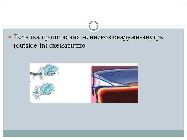  Техника пришивания менисков снаружи-внутрь (outside-in) схематично 