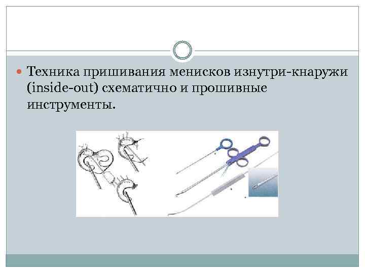  Техника пришивания менисков изнутри-кнаружи (inside-out) схематично и прошивные инструменты. 