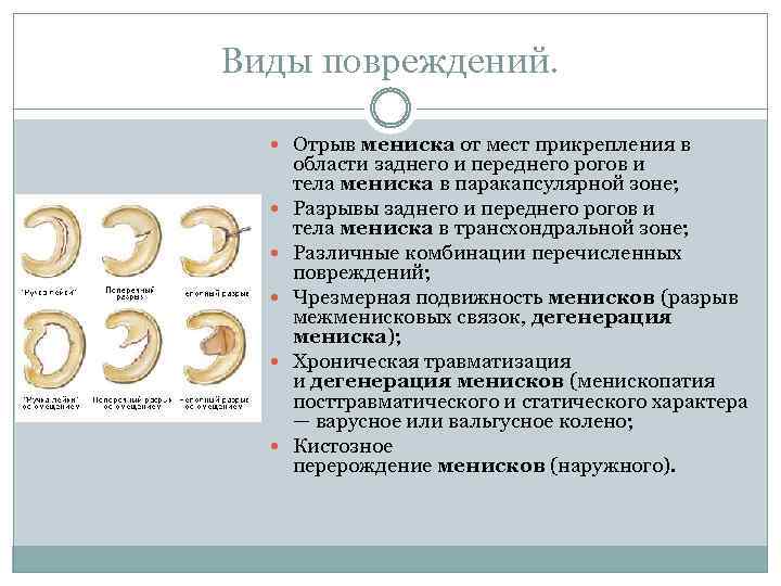 Виды повреждений. Отрыв мениска от мест прикрепления в области заднего и переднего рогов и