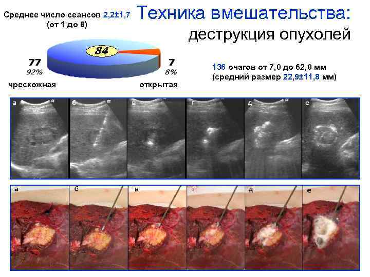 Среднее число сеансов 2, 2± 1, 7 (от 1 до 8) Техника вмешательства: деструкция
