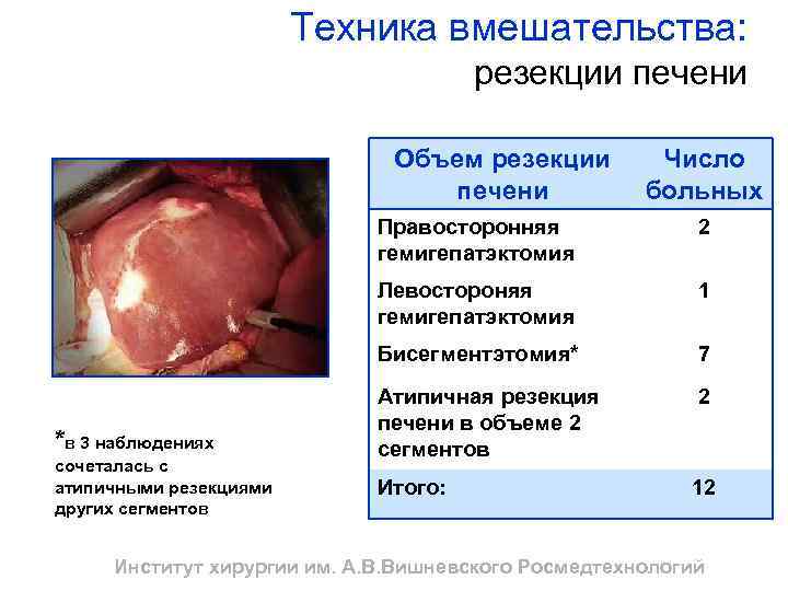 Техника вмешательства: резекции печени Объем резекции печени Число больных Правосторонняя гемигепатэктомия Левостороняя гемигепатэктомия сочеталась