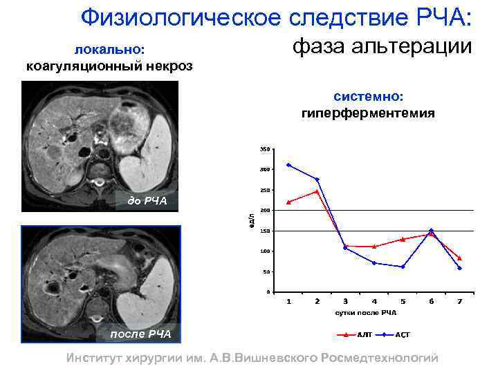Физиологическое следствие РЧА: локально: коагуляционный некроз фаза альтерации системно: гиперферментемия до РЧА после РЧА