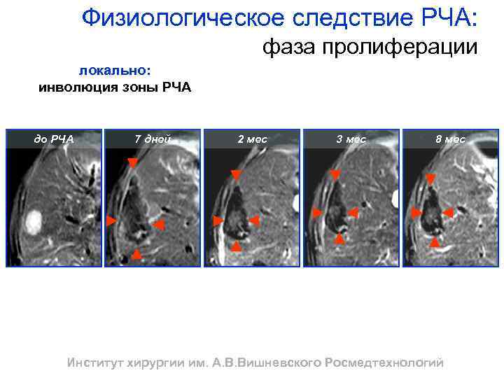 Физиологическое следствие РЧА: фаза пролиферации локально: инволюция зоны РЧА до РЧА 7 дней 2