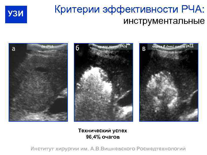 Критерии эффективности РЧА: УЗИ инструментальные до РЧА сразу после РЧА через 6 дней после