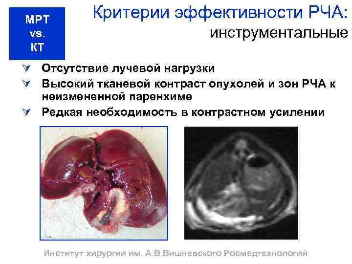 МРТ vs. КТ Критерии эффективности РЧА: инструментальные Ú Отсутствие лучевой нагрузки Ú Высокий тканевой