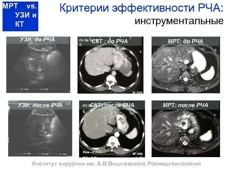 МРТ vs. УЗИ и КТ Критерии эффективности РЧА: УЗИ: до РЧА УЗИ: после РЧА