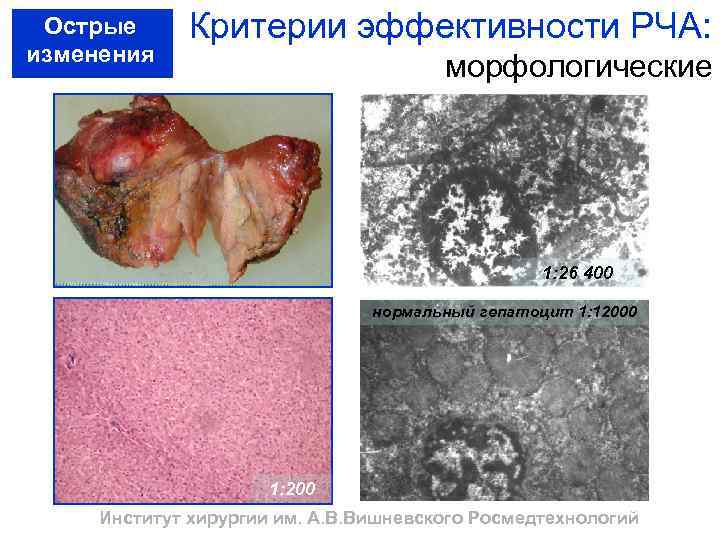 Острые изменения Критерии эффективности РЧА: морфологические 1: 26 400 нормальный гепатоцит 1: 12000 1: