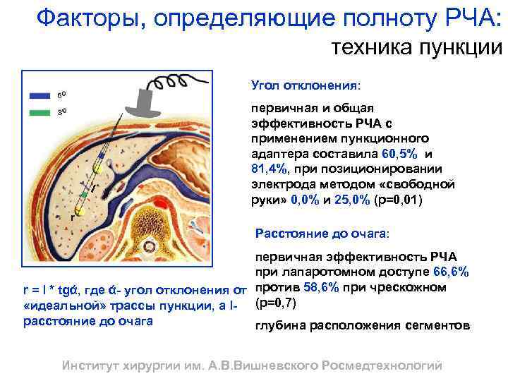 Факторы, определяющие полноту РЧА: техника пункции Угол отклонения: первичная и общая эффективность РЧА с