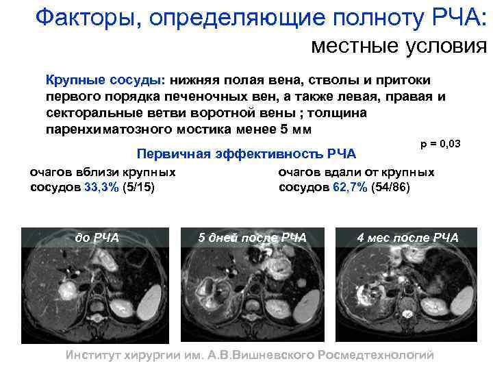 Факторы, определяющие полноту РЧА: местные условия Крупные сосуды: нижняя полая вена, стволы и притоки