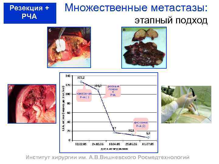 Резекция + РЧА Множественные метастазы: этапный подход Институт хирургии им. А. В. Вишневского Росмедтехнологий