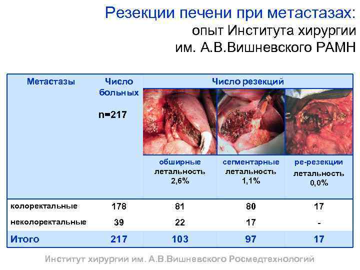 Резекции печени при метастазах: опыт Института хирургии им. А. В. Вишневского РАМН Метастазы Число