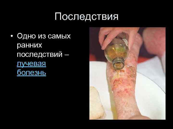 Последствия • Одно из самых ранних последствий – лучевая болезнь 