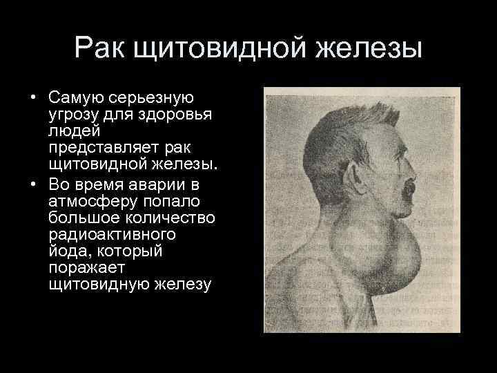 Рак щитовидной железы • Самую серьезную угрозу для здоровья людей представляет рак щитовидной железы.