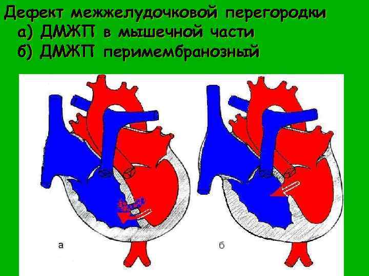 Дефект межжелудочковой перегородки а) ДМЖП в мышечной части б) ДМЖП перимембранозный 