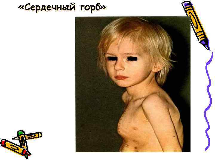  «Сердечный горб» 