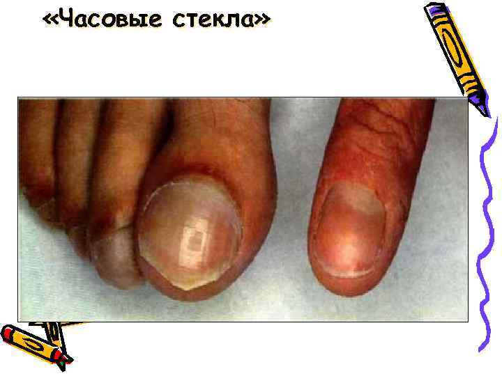  «Часовые стекла» 