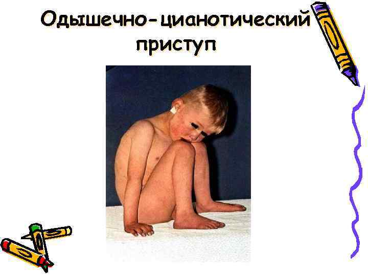 Одышечно-цианотический приступ 