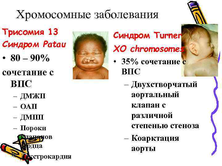 Хромосомные заболевания Трисомия 13 Синдром Patau • 80 – 90% сочетание с ВПС –