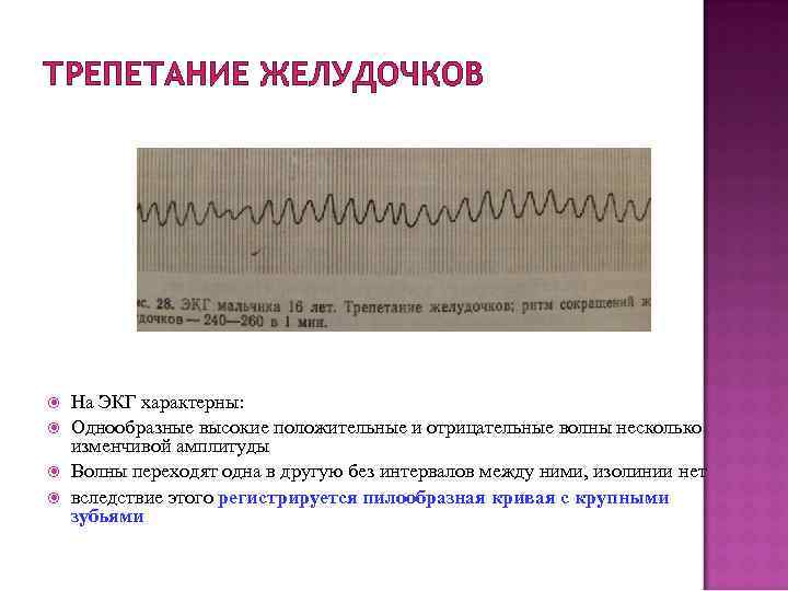 ТРЕПЕТАНИЕ ЖЕЛУДОЧКОВ На ЭКГ характерны: Однообразные высокие положительные и отрицательные волны несколько изменчивой амплитуды