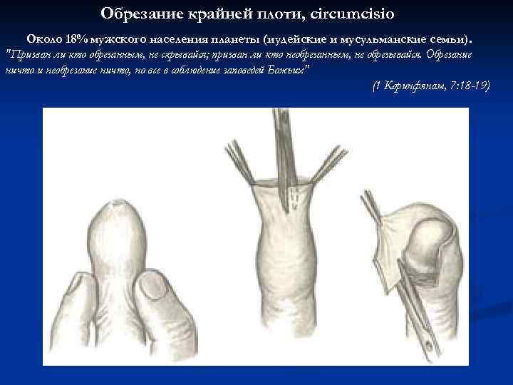 Обрезание крайней плоти, circumcisio Около 18% мужского населения планеты (иудейские и мусульманские семьи). 