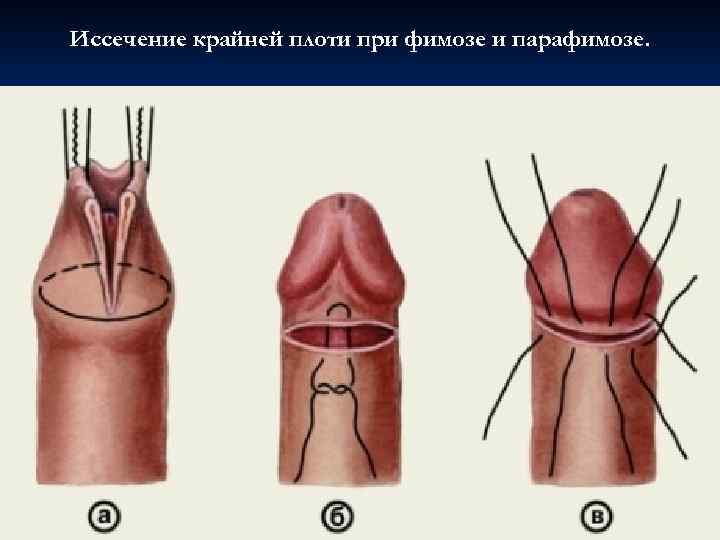 Иссечение крайней плоти при фимозе и парафимозе. 