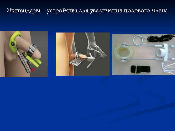 Экстендеры – устройства для увеличения полового члена 
