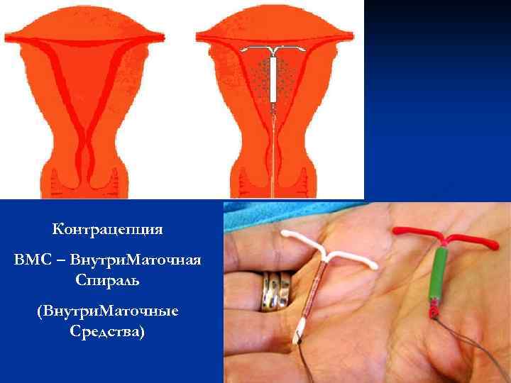 Контрацепция ВМС – Внутри. Маточная Спираль (Внутри. Маточные Средства) 