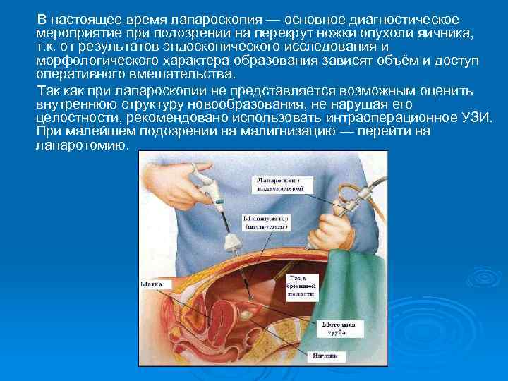 В настоящее время лапароскопия — основное диагностическое мероприятие при подозрении на перекрут ножки опухоли