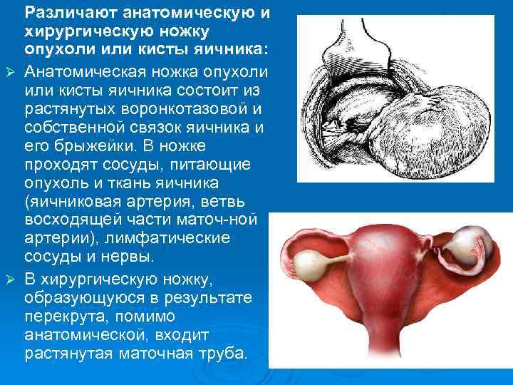 Различают анатомическую и хирургическую ножку опухоли или кисты яичника: Ø Анатомическая ножка опухоли или