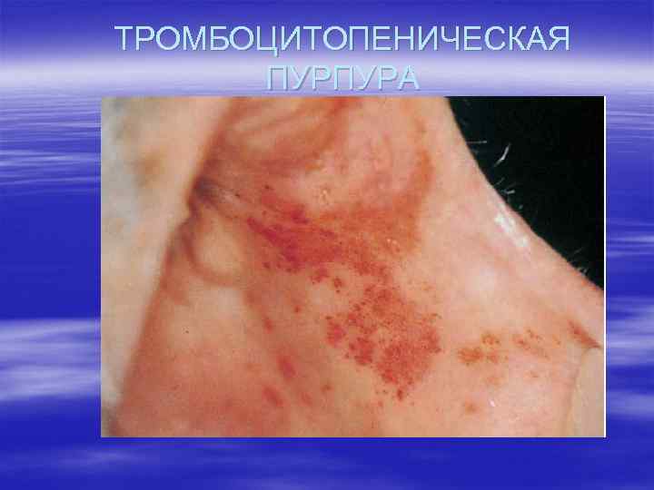 ТРОМБОЦИТОПЕНИЧЕСКАЯ ПУРПУРА 
