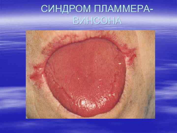 СИНДРОМ ПЛАММЕРАВИНСОНА 