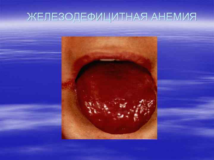 ЖЕЛЕЗОДЕФИЦИТНАЯ АНЕМИЯ 