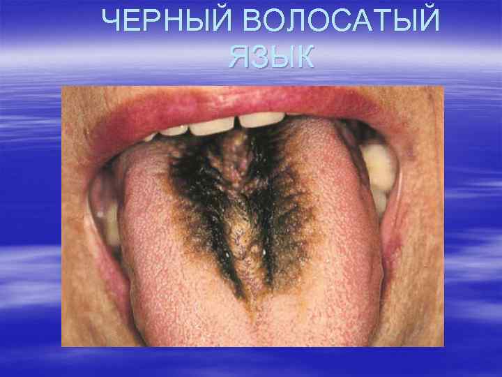 ЧЕРНЫЙ ВОЛОСАТЫЙ ЯЗЫК 