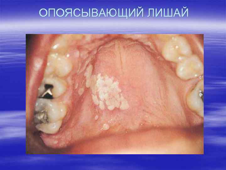 ОПОЯСЫВАЮЩИЙ ЛИШАЙ 