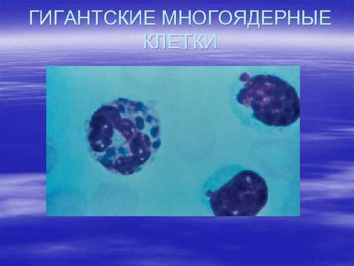 ГИГАНТСКИЕ МНОГОЯДЕРНЫЕ КЛЕТКИ 
