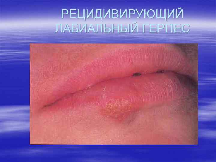 РЕЦИДИВИРУЮЩИЙ ЛАБИАЛЬНЫЙ ГЕРПЕС 