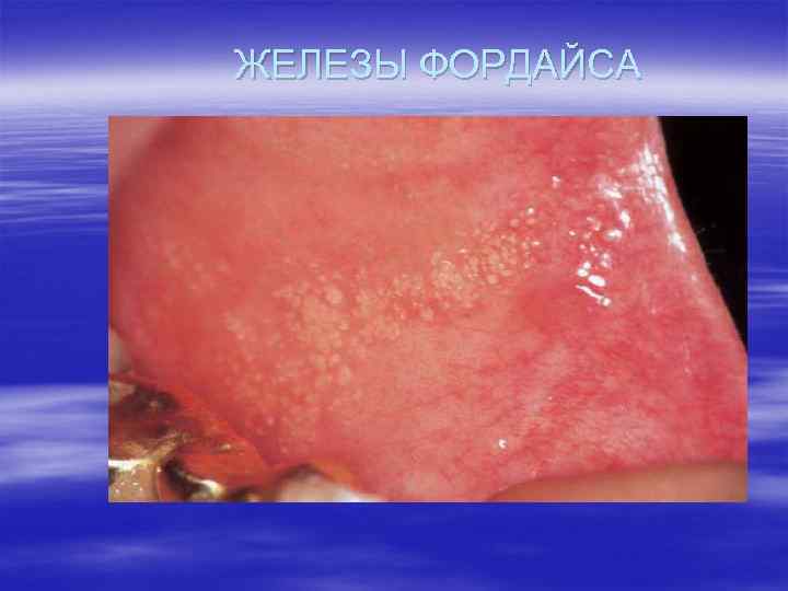 ЖЕЛЕЗЫ ФОРДАЙСА 