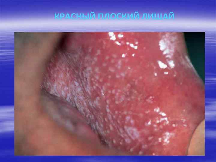 КРАСНЫЙ ПЛОСКИЙ ЛИШАЙ 