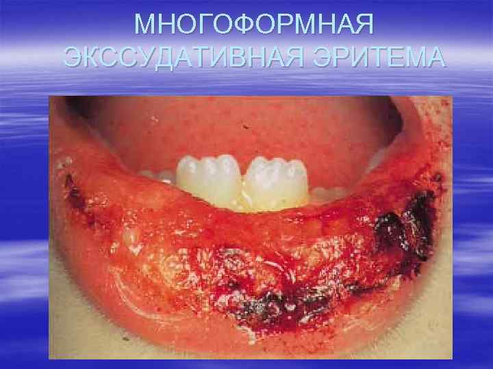 МНОГОФОРМНАЯ ЭКССУДАТИВНАЯ ЭРИТЕМА 