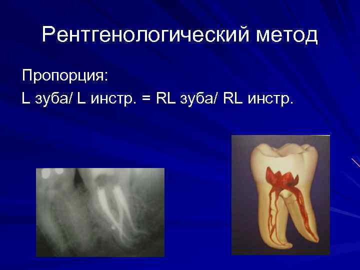 Рентгенологический метод Пропорция: L зуба/ L инстр. = RL зуба/ RL инстр. 